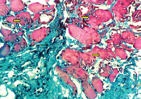Section with trichrome stain highlighting the necrotic and atrophic myofibres (thick yellow arrows) and intervening fibrosis (black arrows) (Masson trichrome, ×400).